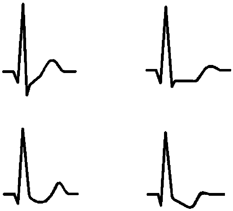 Electrocardiosignal ST section automatic judging method and device based on artificial intelligent technology