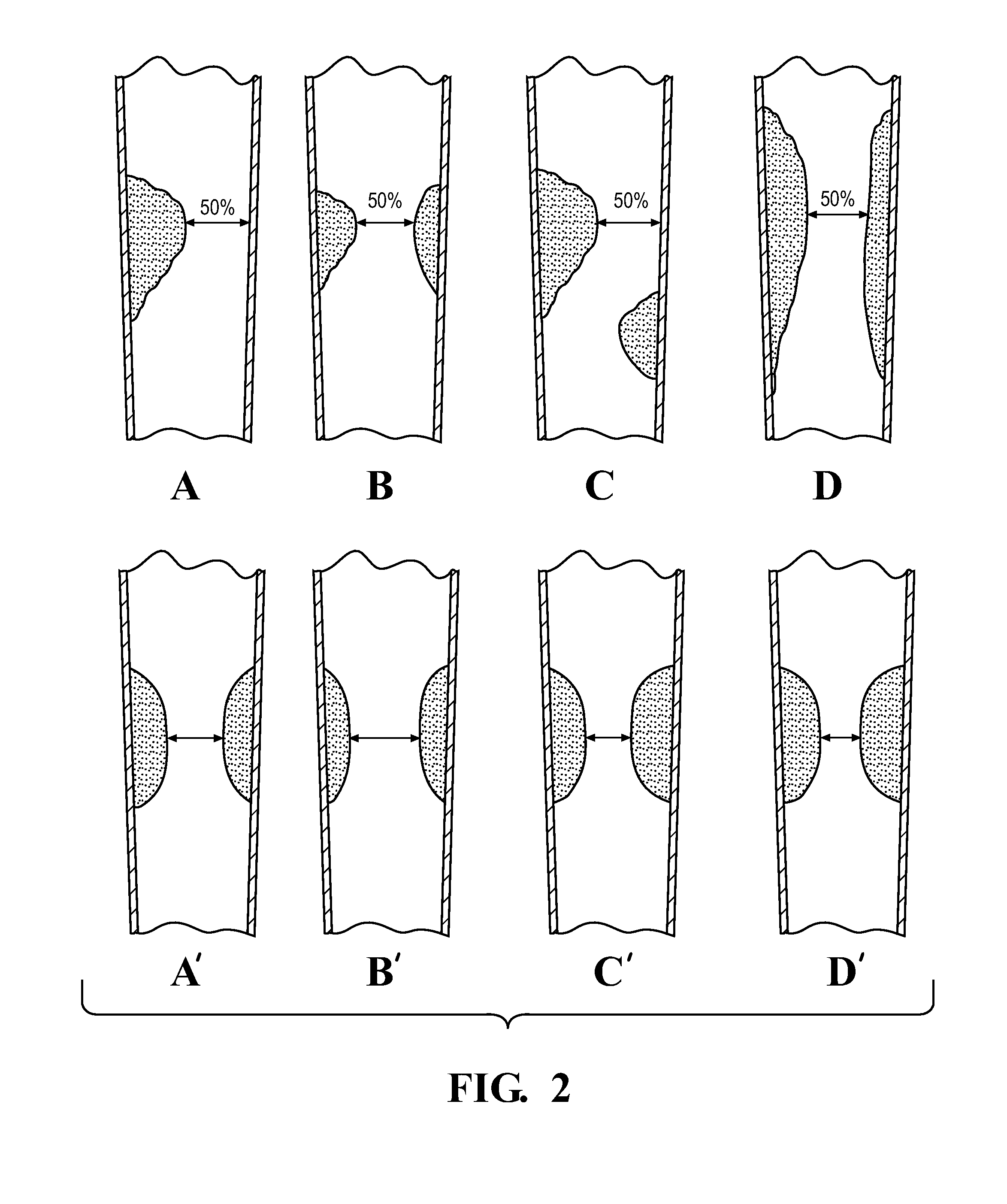 Method for assessing stenosis severity through stenosis mapping