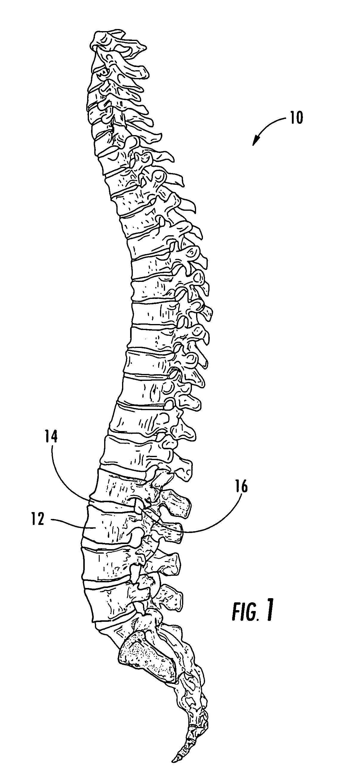 Method and apparatus for treatment of discogenic pain