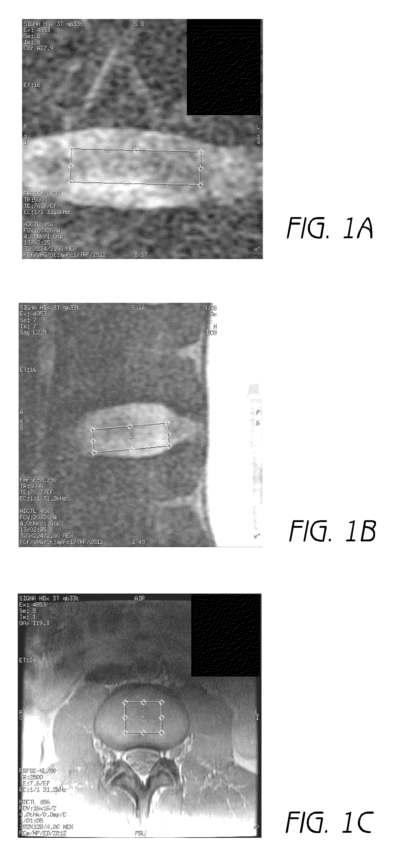 MR spectroscopy system and method for diagnosing painful and non-painful  intervertebral discs
