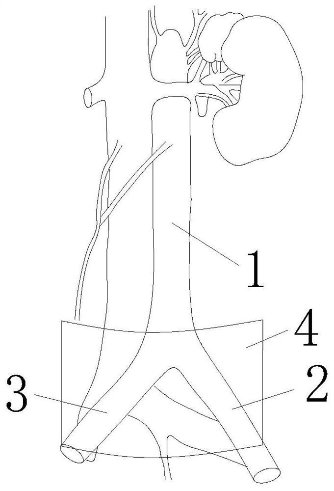 A hemostatic device for prehospital incompressible trunk bleeding