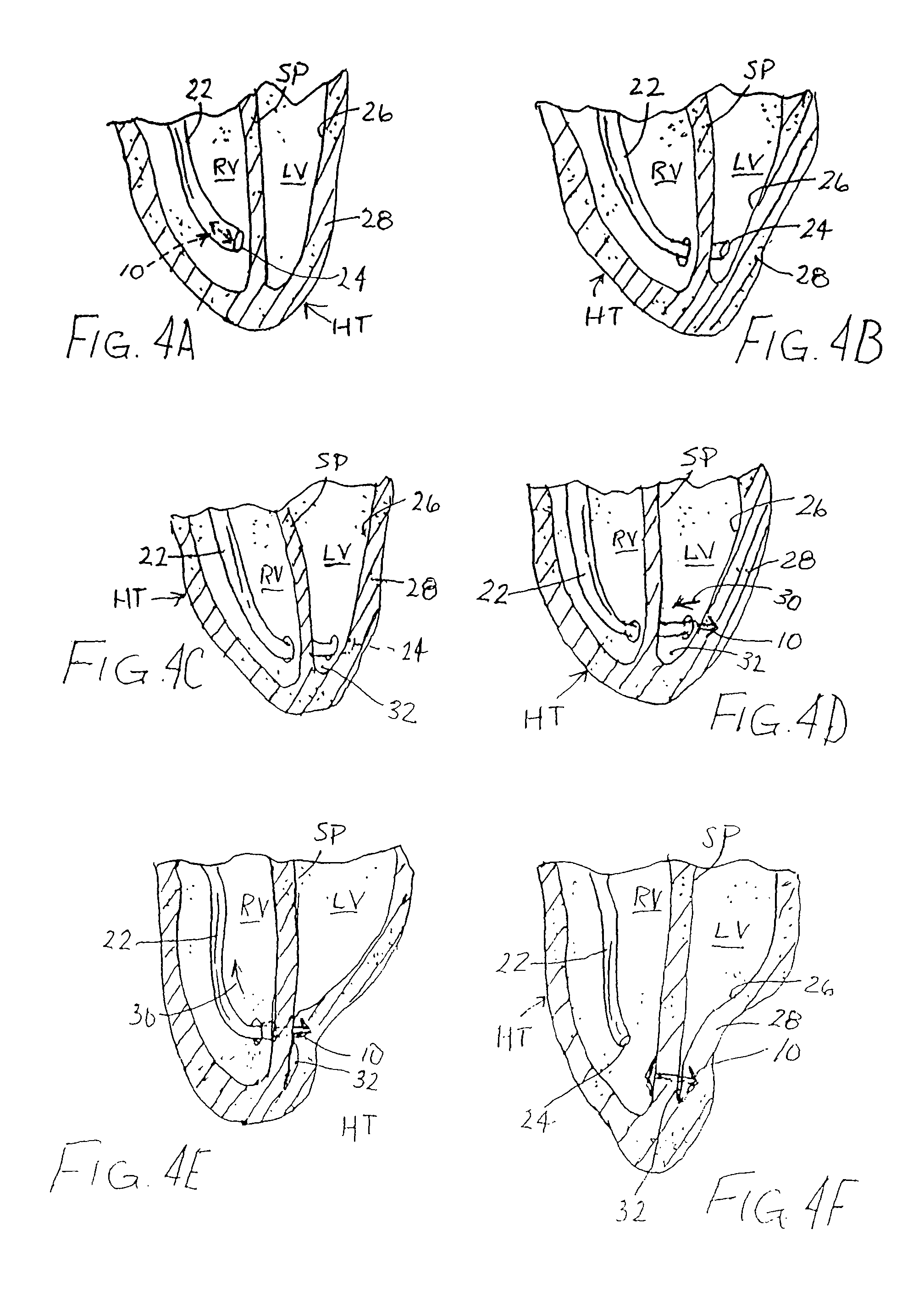Method and device for improving cardiac function