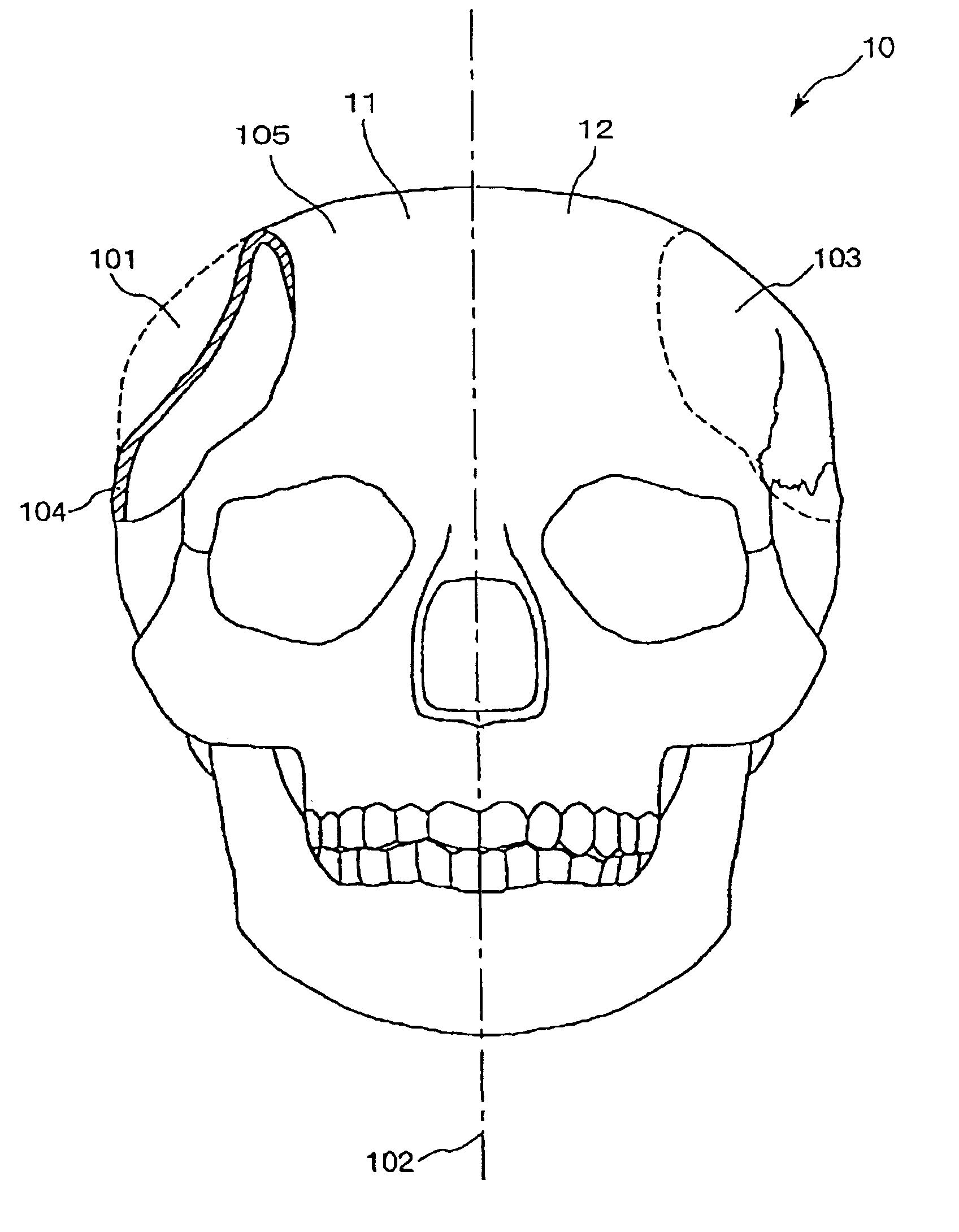 Method for modeling an implant and an implant manufactured by the method