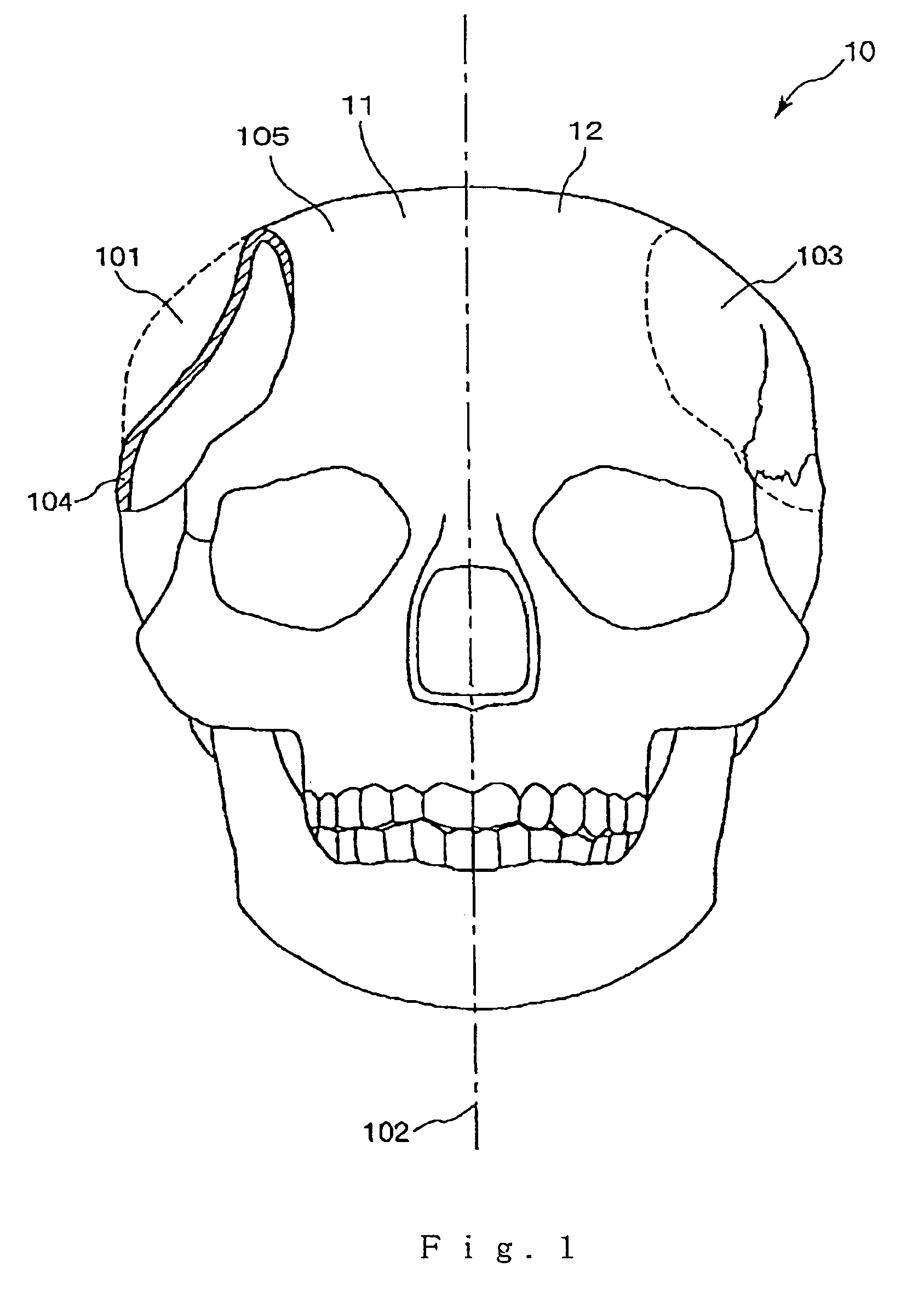 Method for modeling an implant and an implant manufactured by the method