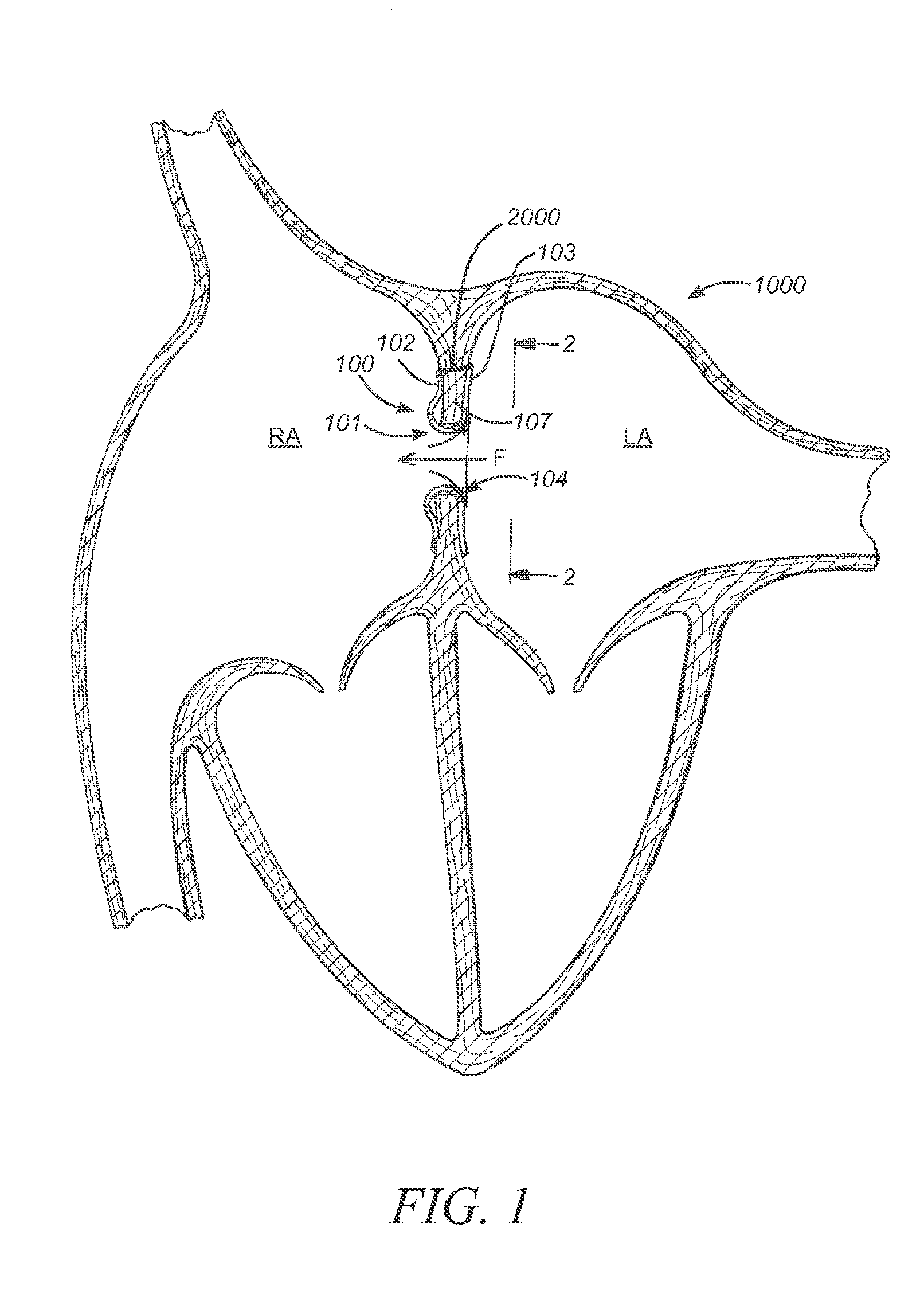 Devices and methods for coronary sinus pressure relief