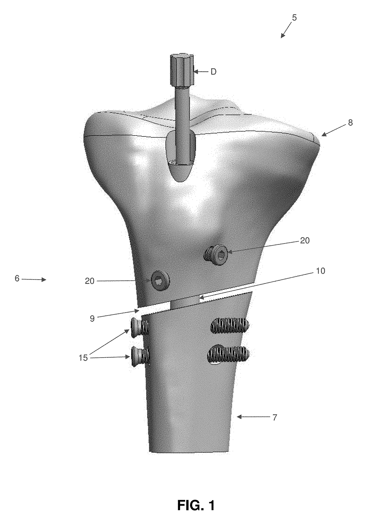 Interlocking intramedullary rod assembly for treating proximal tibial fractures