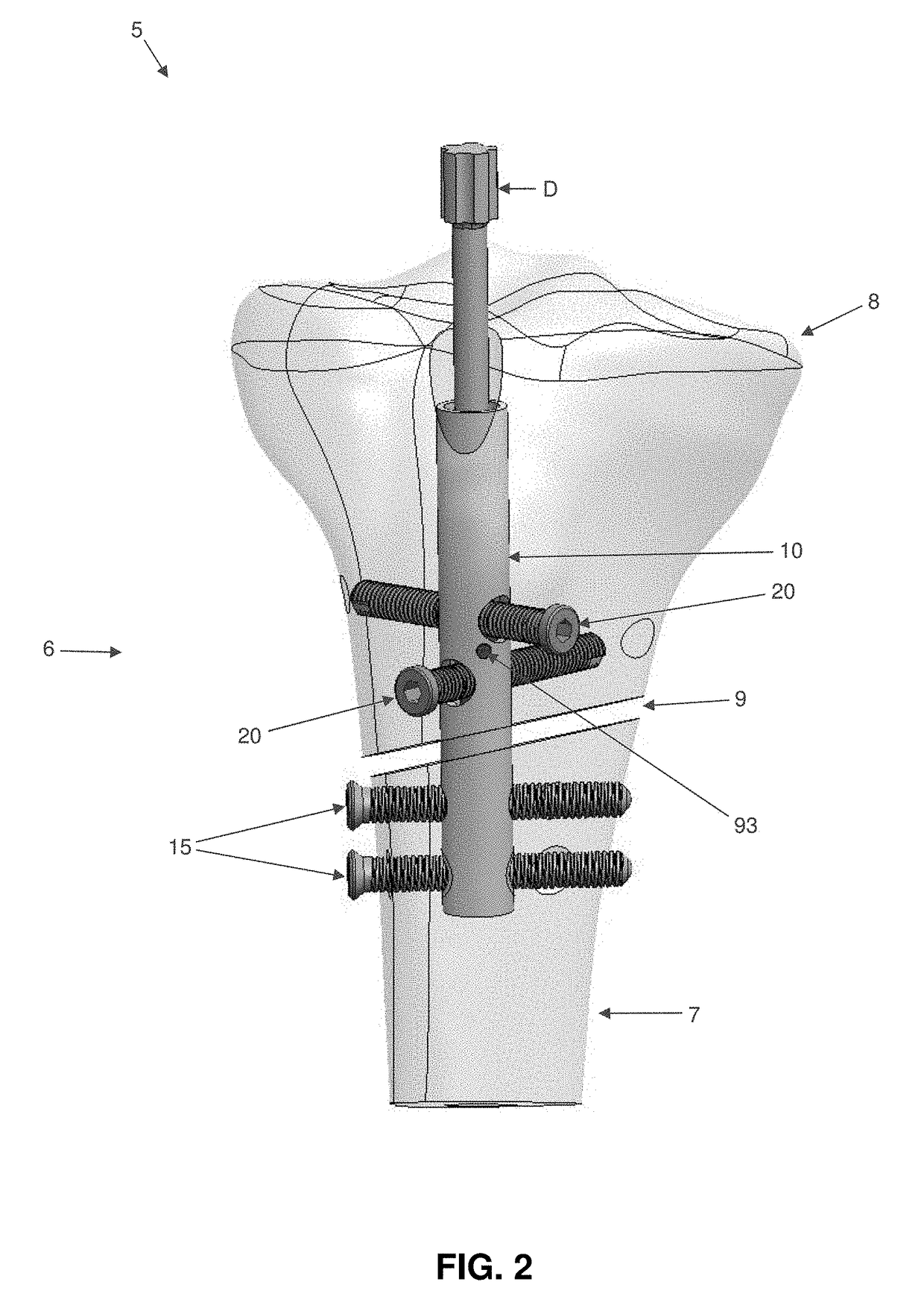 Interlocking intramedullary rod assembly for treating proximal tibial fractures