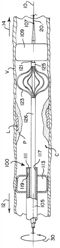 Intravascular plaque isolation, destabilization, and aspiration