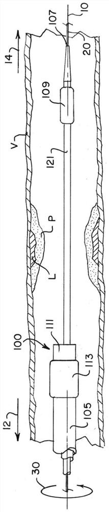 Intravascular plaque isolation, destabilization, and aspiration