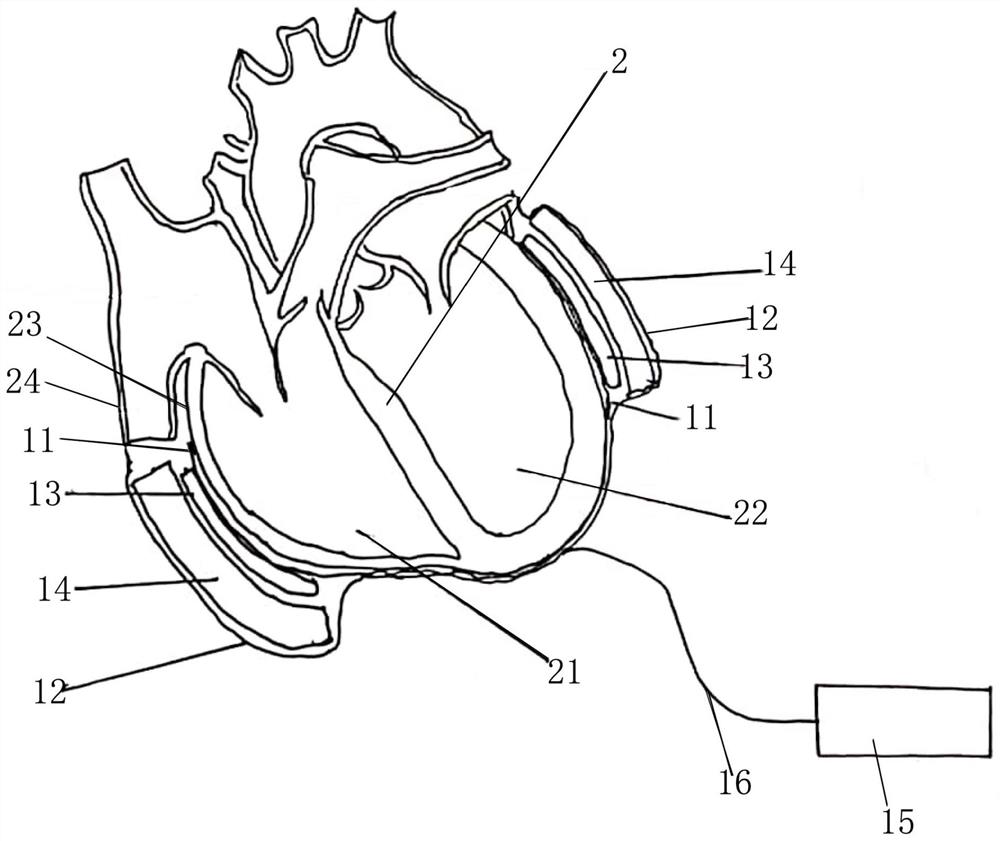 Electromagnetic cardiac pulse assisting device