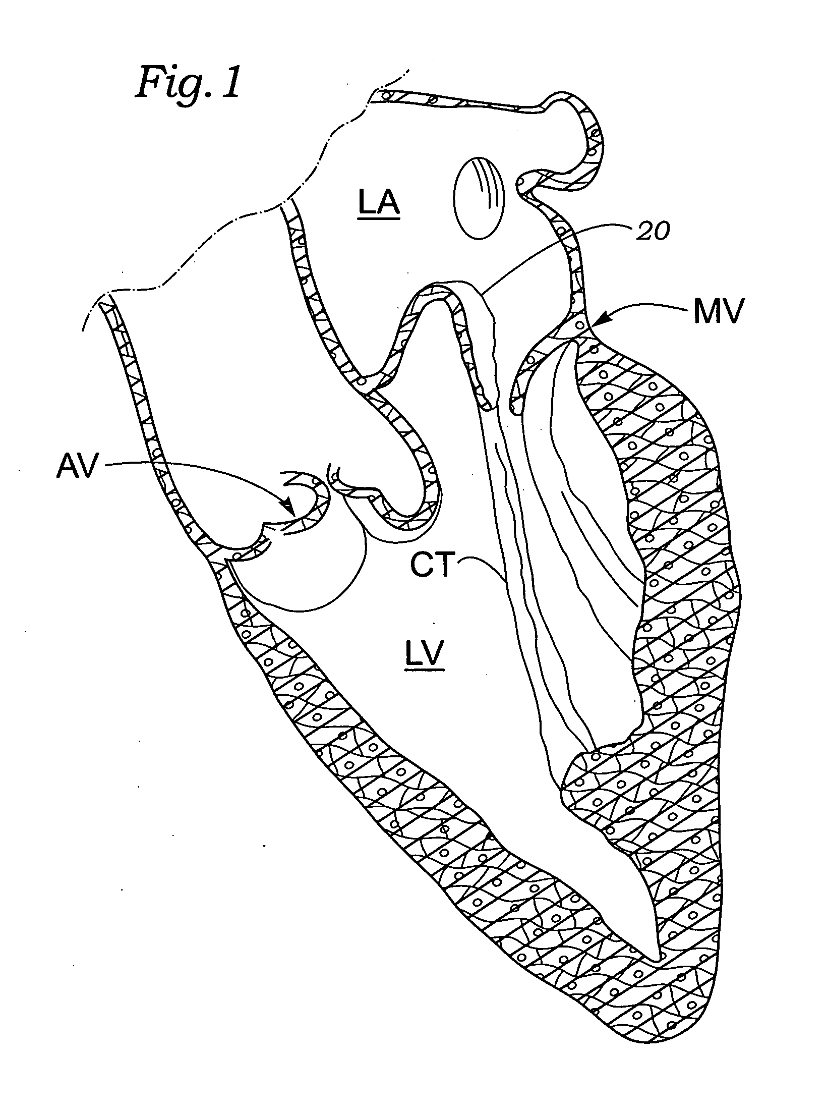 Saddle-shaped annuloplasty ring
