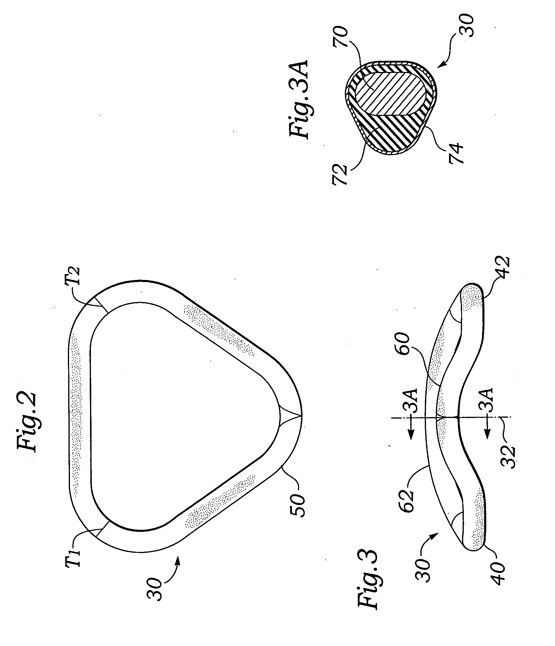 Saddle-shaped annuloplasty ring