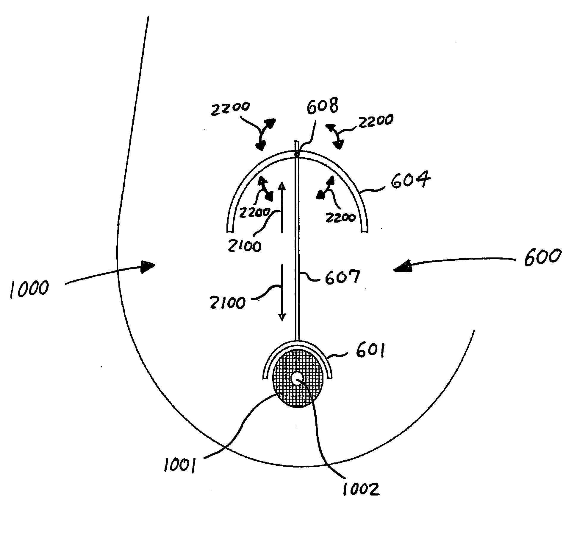 Apparatus and method for optimizing a surgical incision on the breast