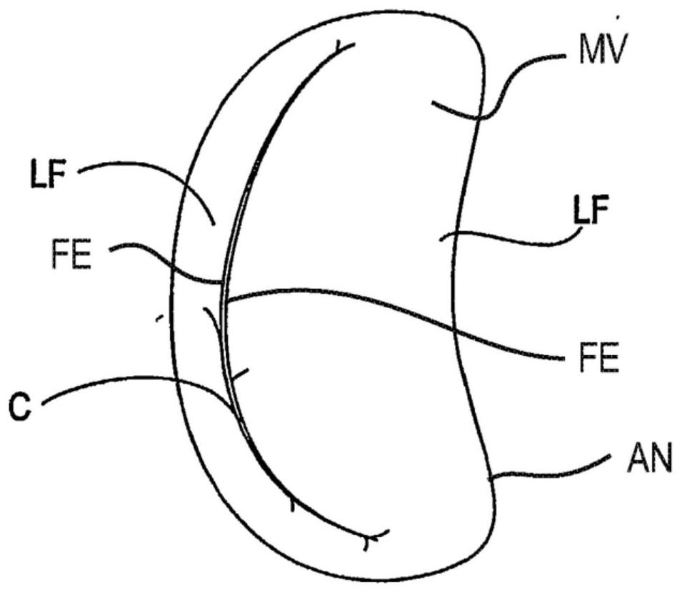 Improved tissue fixation device