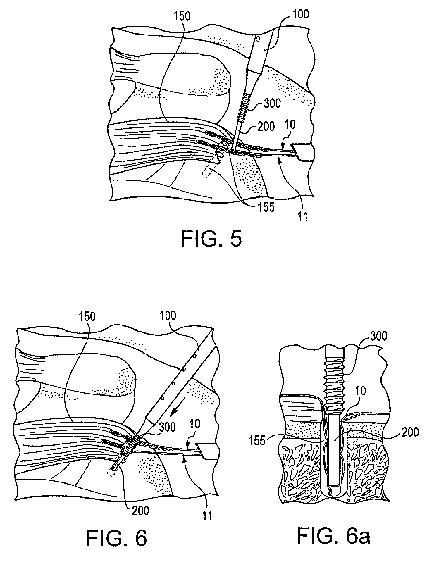Fenestrated suture anchor and method for knotless fixation of tissue