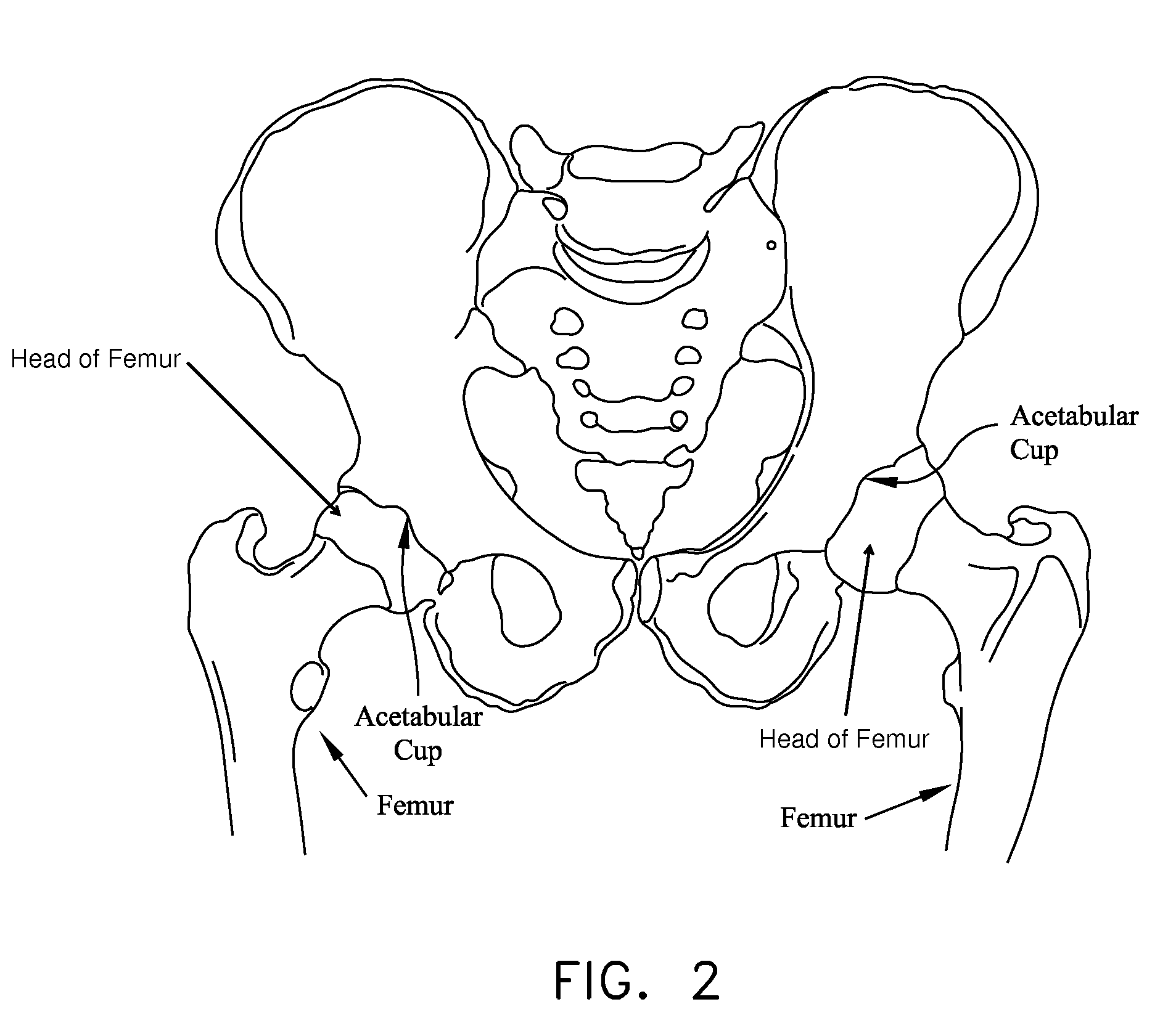 Method and apparatus for treating a hip joint, including the provision and use of a novel suture passer