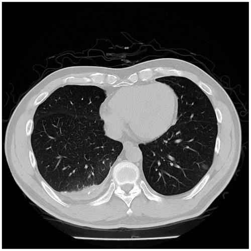 Integrated learning grading method for new coronal pneumonia, electronic equipment and storage medium