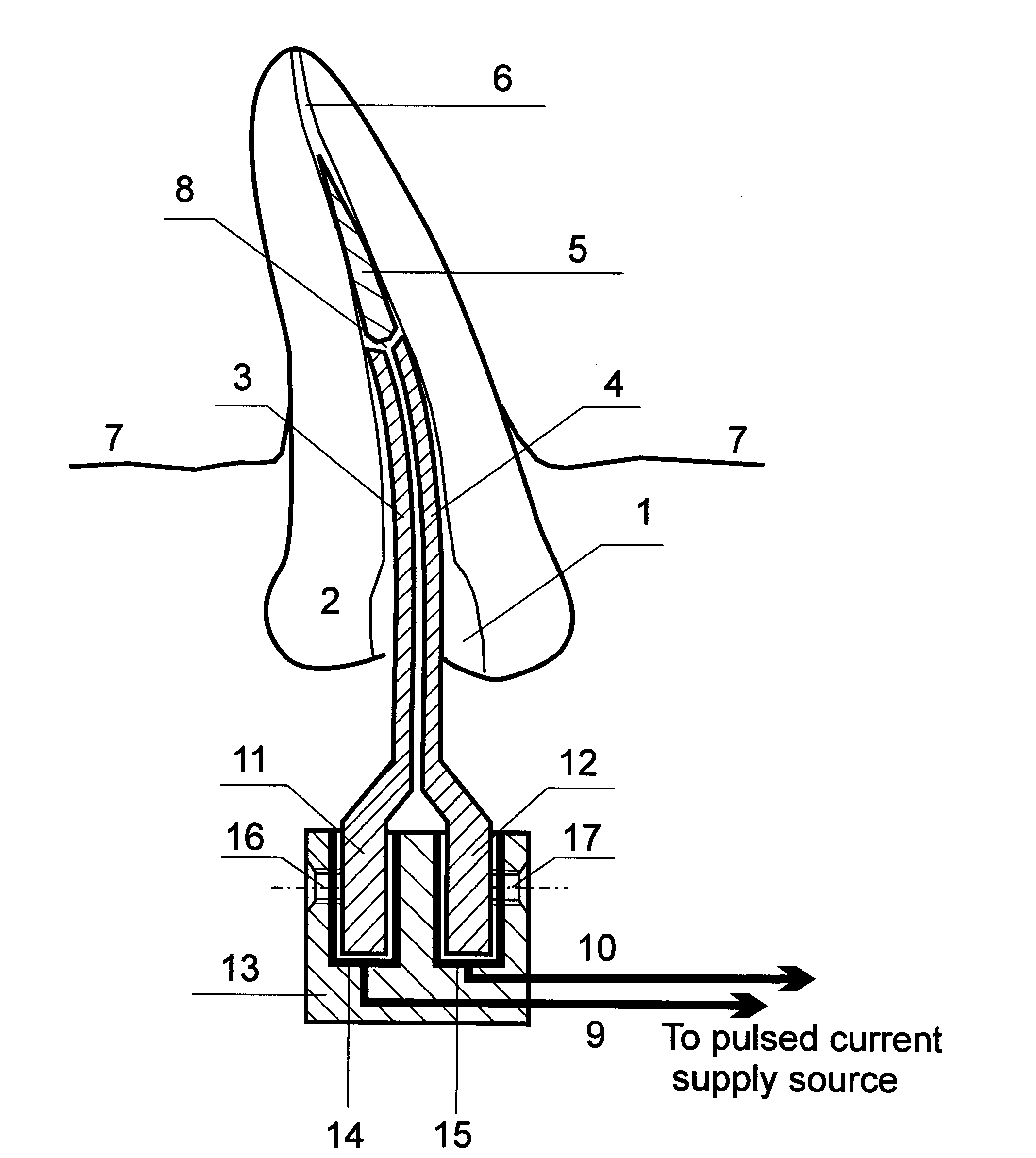 Method for removing a tool fragment from a tooth root canal and an extractor for carrying out said method