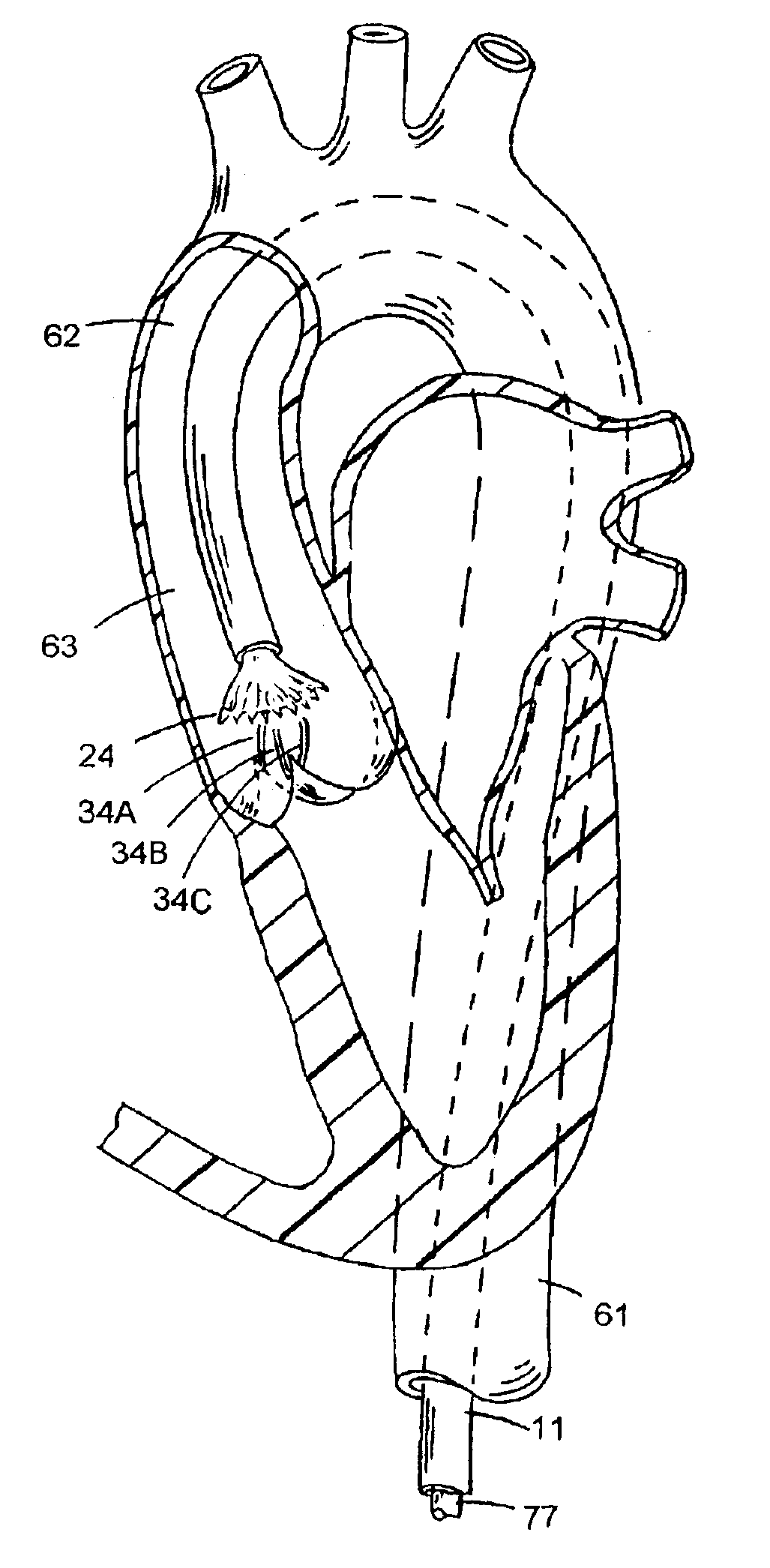 Apparatus and methods for valve removal
