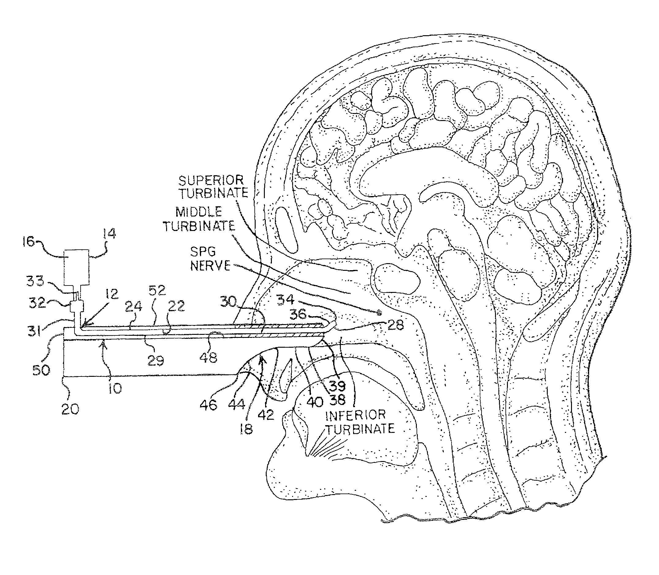 Devices for Delivering a Medicament and Methods for Ameliorating Pain