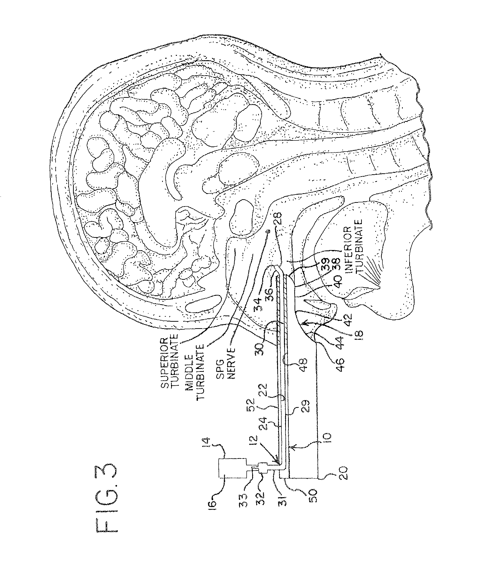 Devices for Delivering a Medicament and Methods for Ameliorating Pain