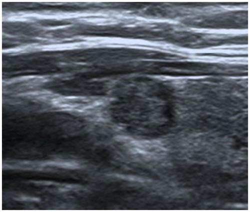 Thyroid nodule ultrasonic image processing method based on cross-layer sparse cavity convolution