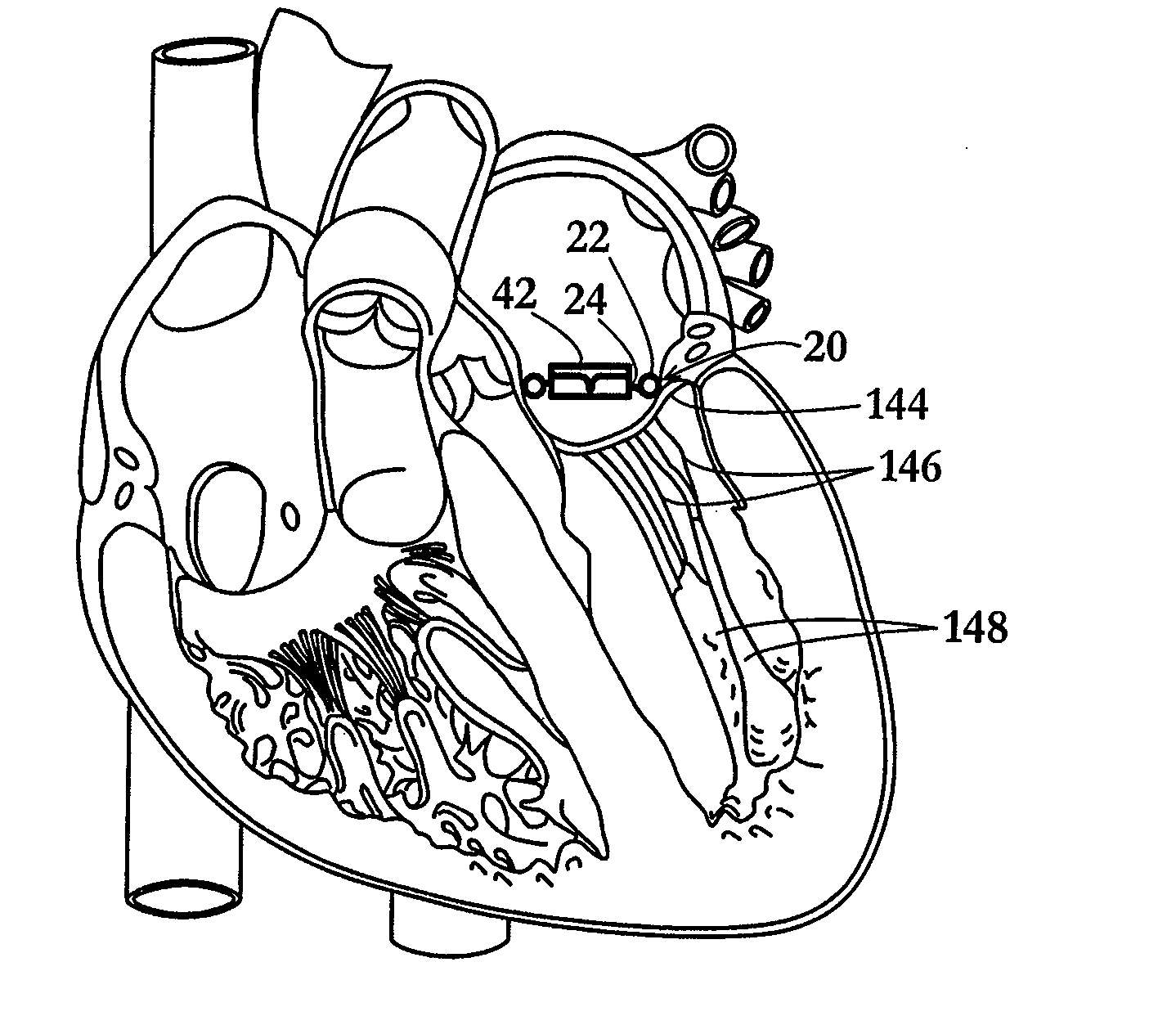 Device and method for temporary or permanent suspension of an implantable scaffolding containing an orifice for placement of a prosthetic or bio-prosthetic valve