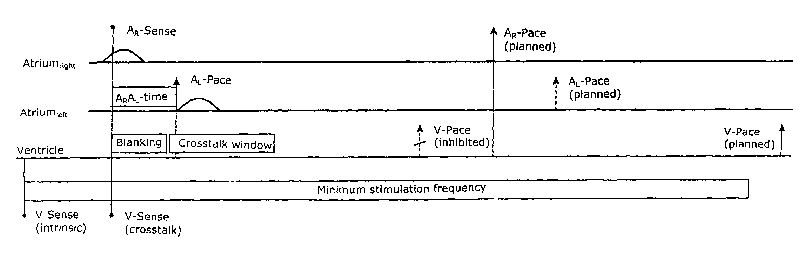 Biatrial triple-chamber cardiac pacemaker with multi-conditional inhibition of second atrial stimulation