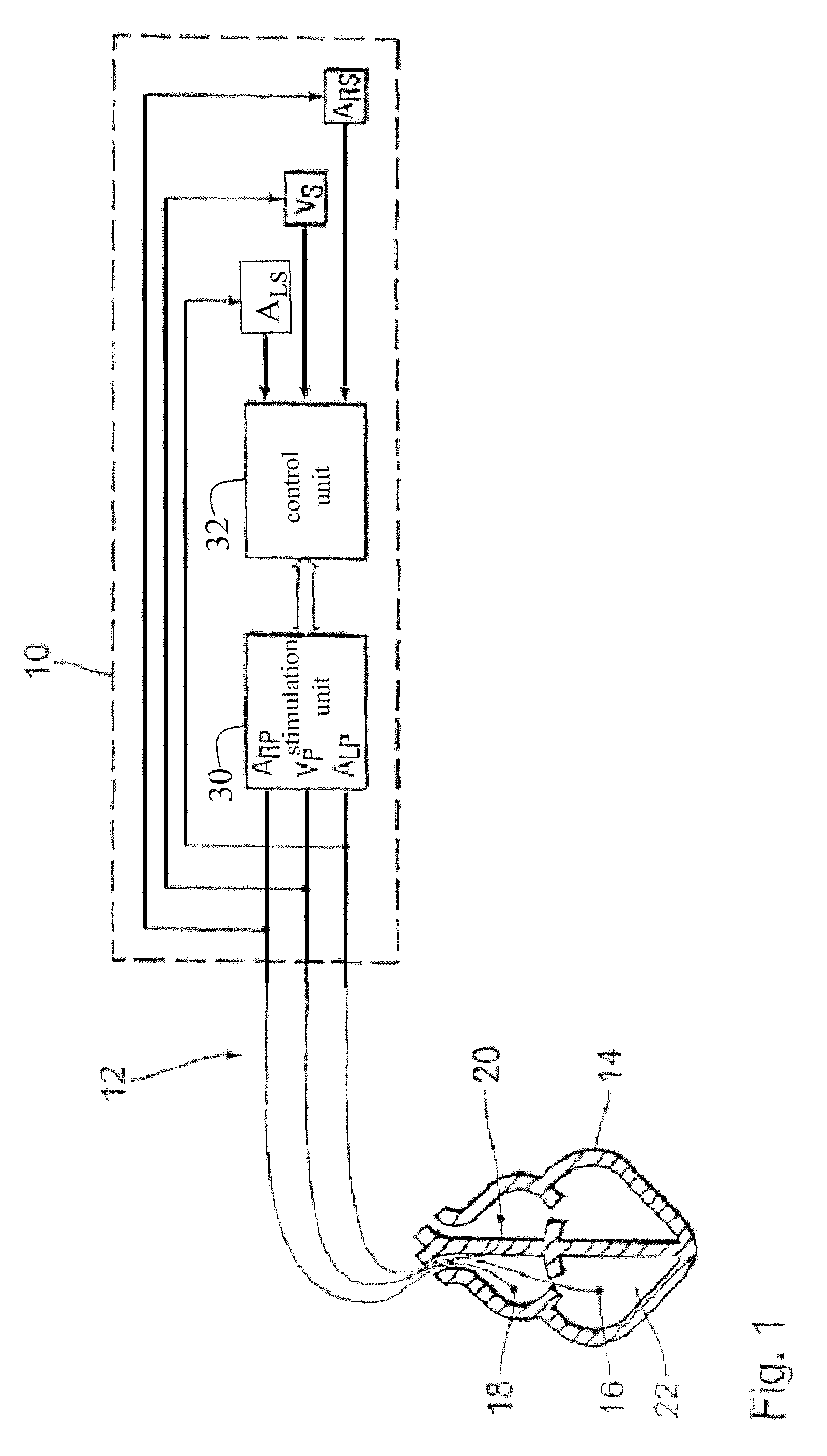 Biatrial triple-chamber cardiac pacemaker with multi-conditional inhibition of second atrial stimulation