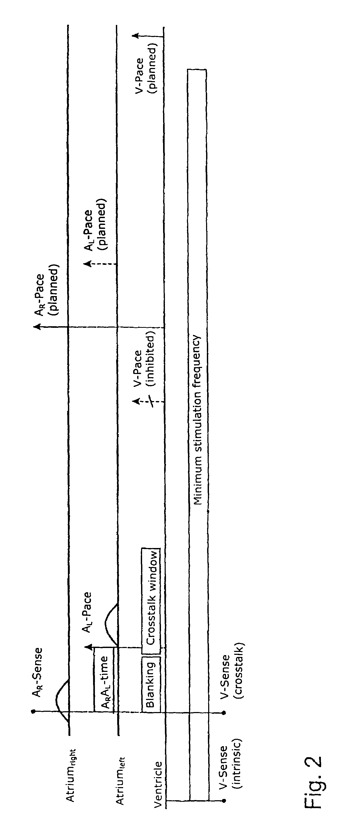 Biatrial triple-chamber cardiac pacemaker with multi-conditional inhibition of second atrial stimulation