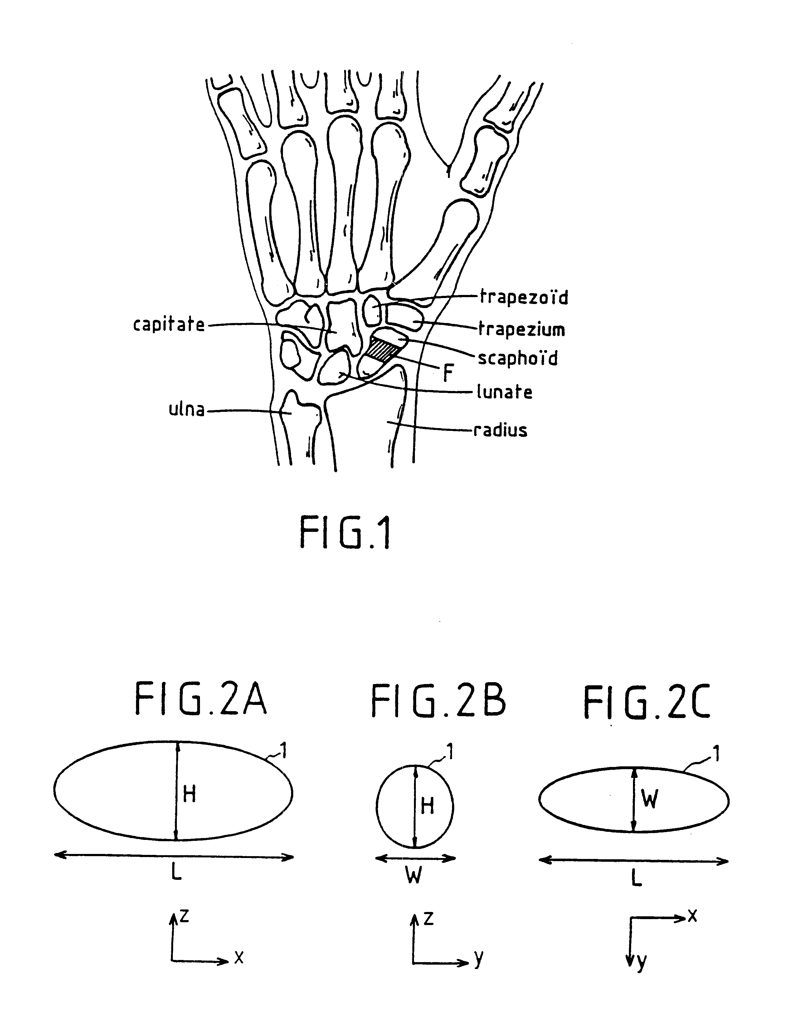 Implant for treating ailments of a joint or a bone