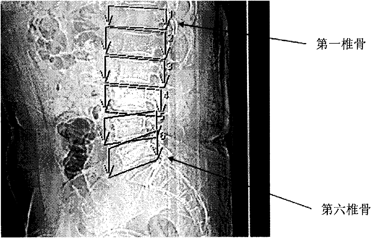 Method and device for positioning vertebras and intervertebral discs