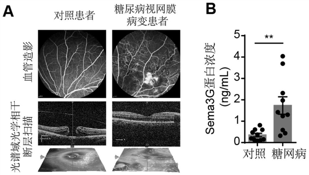 Medical application of recombinant protein Semaphorin3G in prevention and treatment of retinal diseases