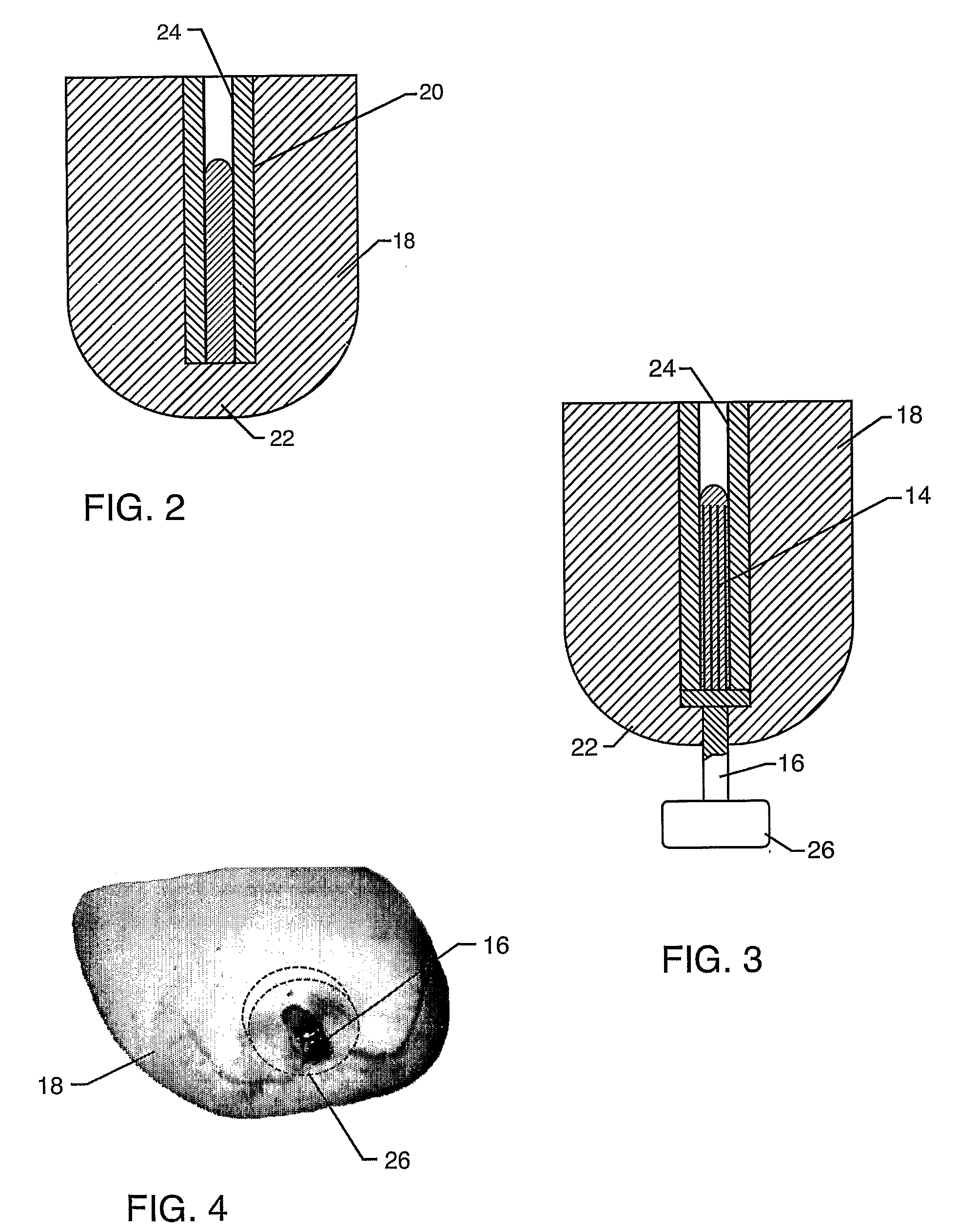 Releasible Attachment System For a Prosthetic Limb