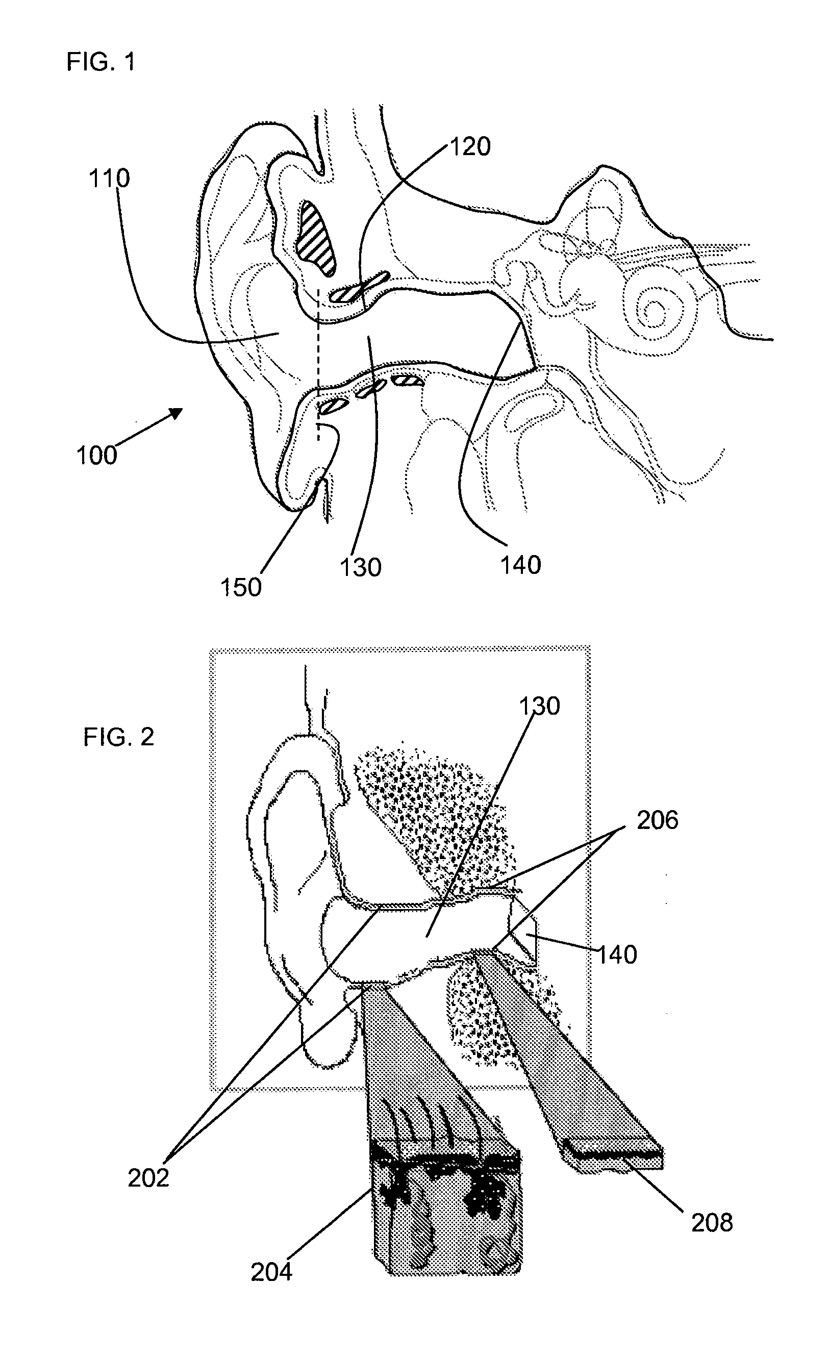 Method and device for acoustic sealing and occlusion effect mitigation