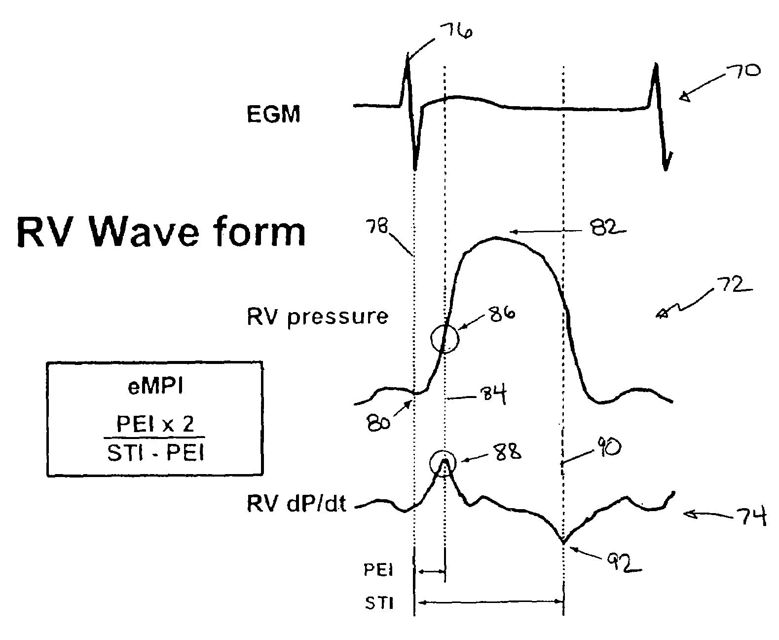 System and method for monitoring myocardial performance using sensed ventricular pressures