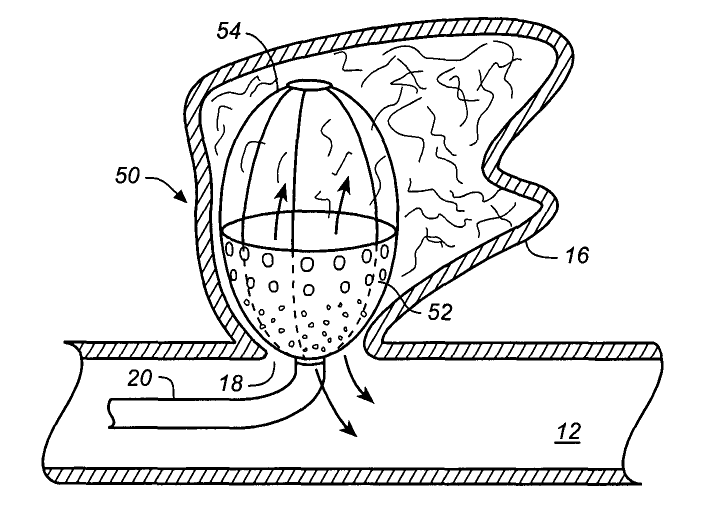 Expandable body cavity liner device
