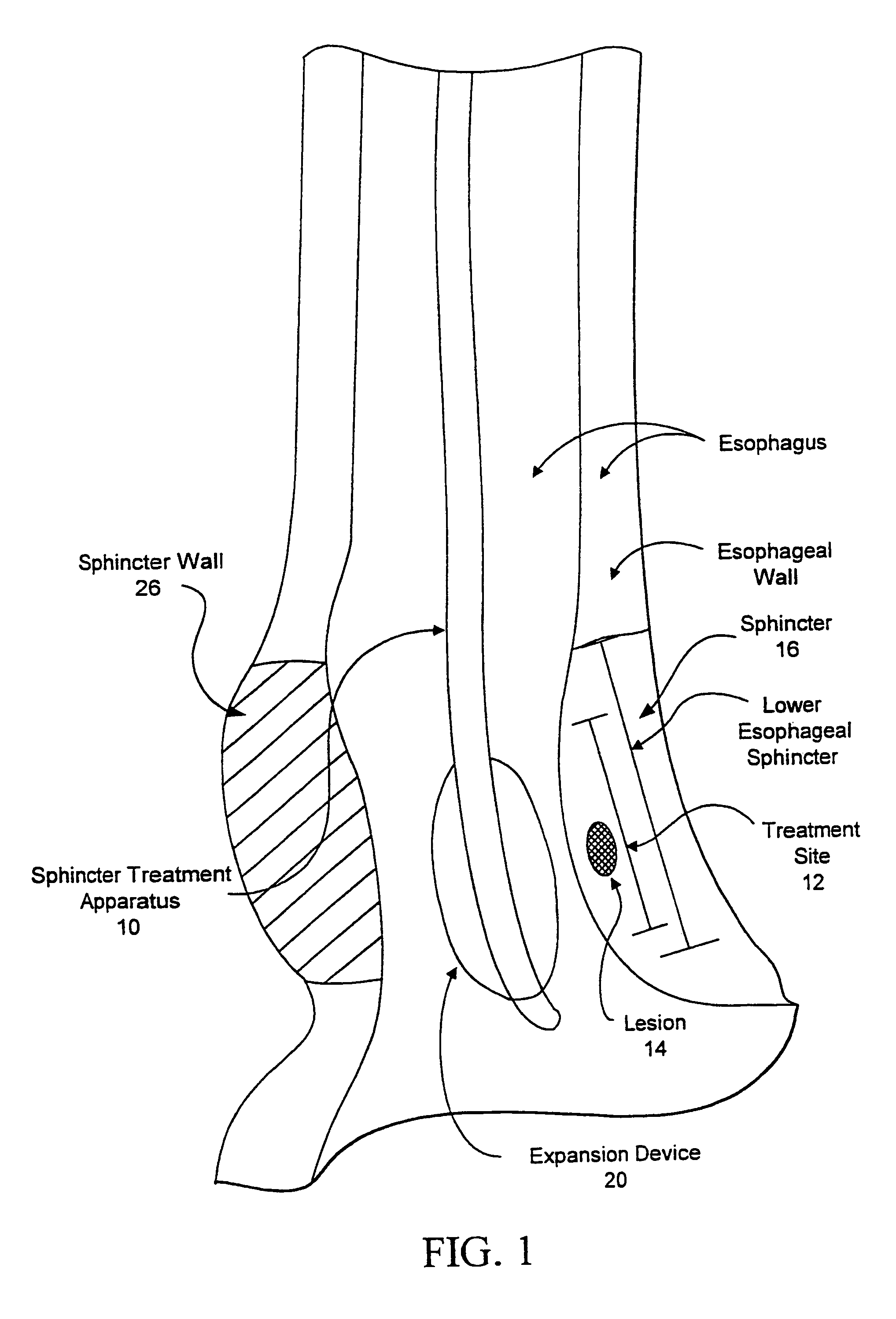 Sphincter treatment apparatus