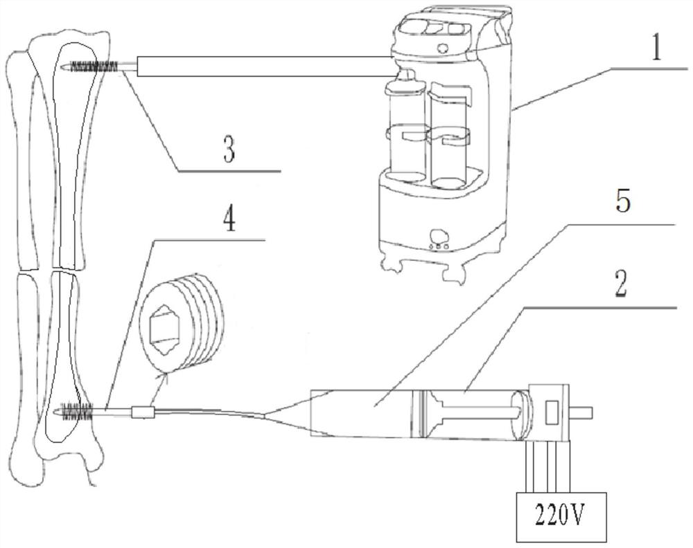 Negative pressure environment bone cement single hole injection fracture fixation system and working method