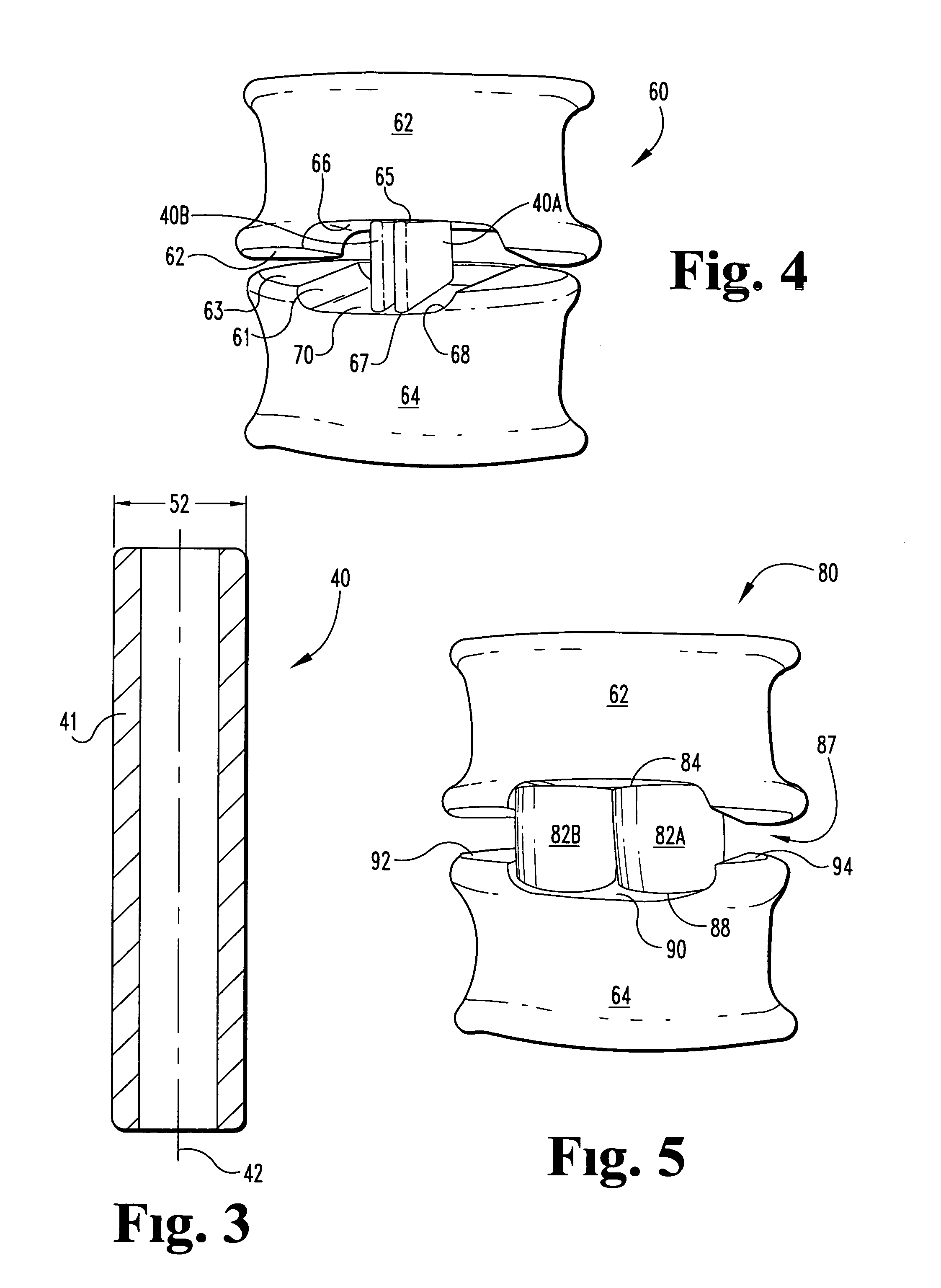 Laterally expanding intervertebral fusion device