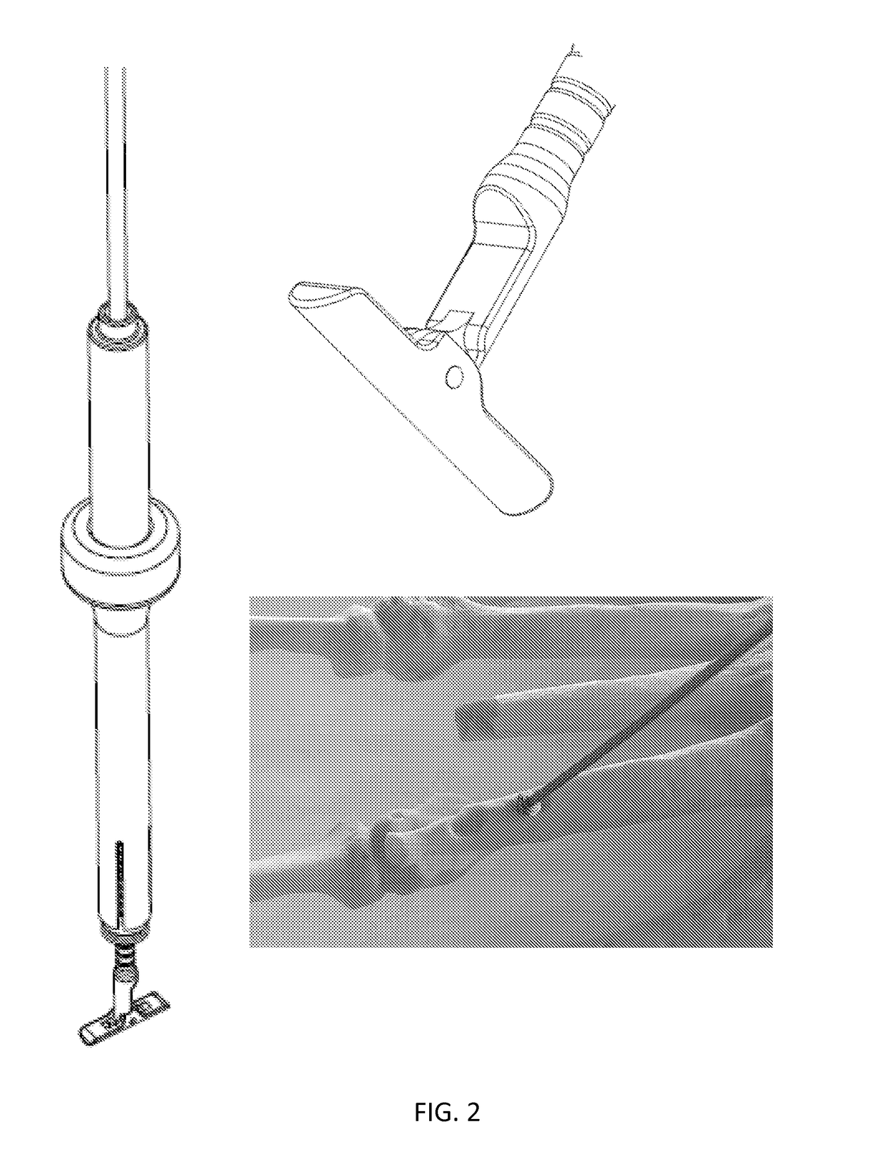 Compression fixation system