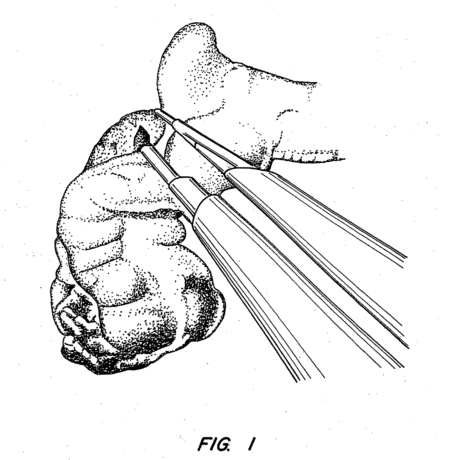 Apparatus and method for endoscopic colectomy