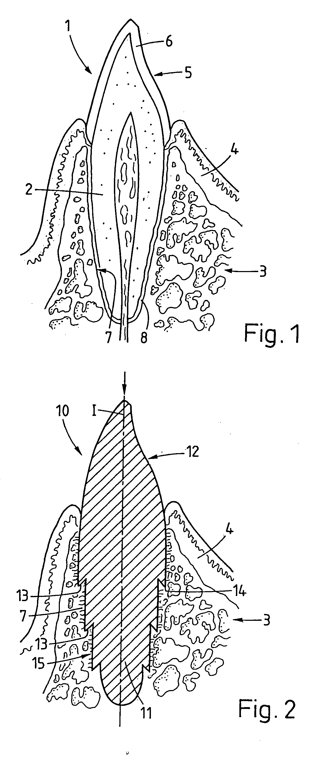 Implant that can be implanted in osseous tissue and method for producing said implant corresponding implant