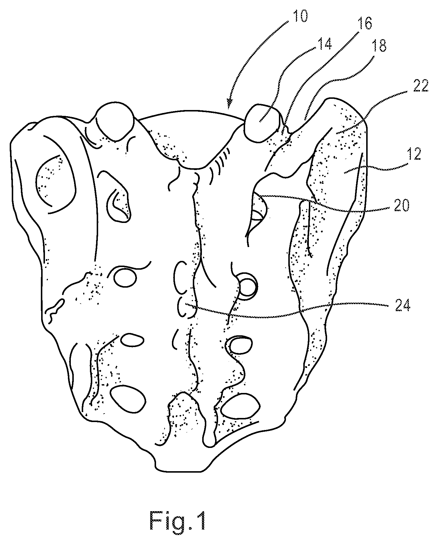 Kit and methods for medical procedures within a sacrum