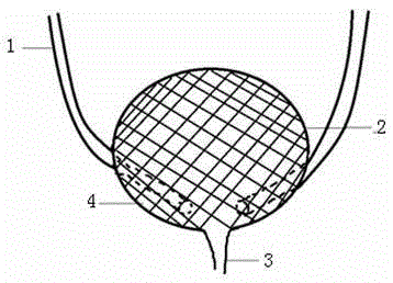 A degradable spherical artificial bladder