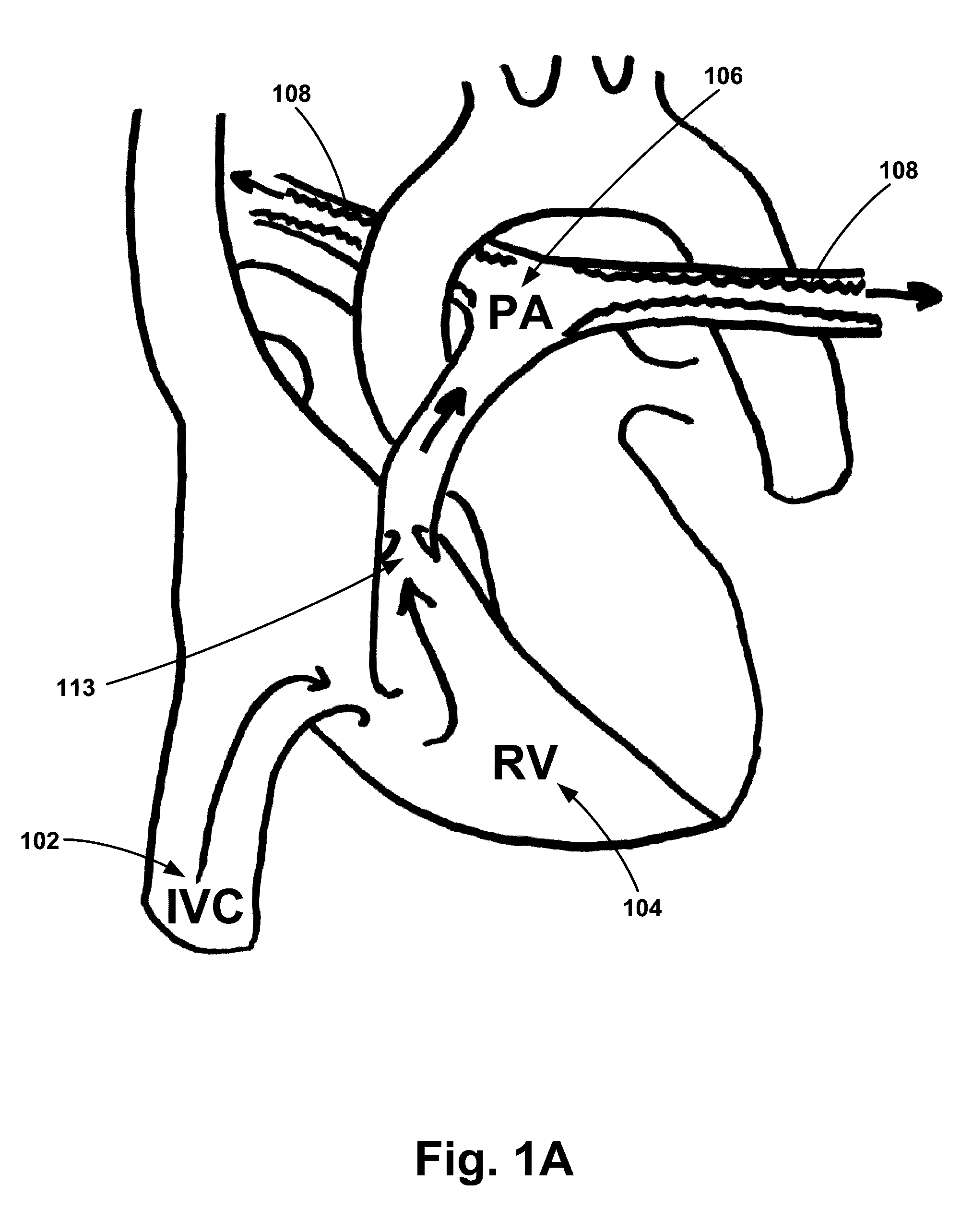 Pulmonary Embolism Apparatus