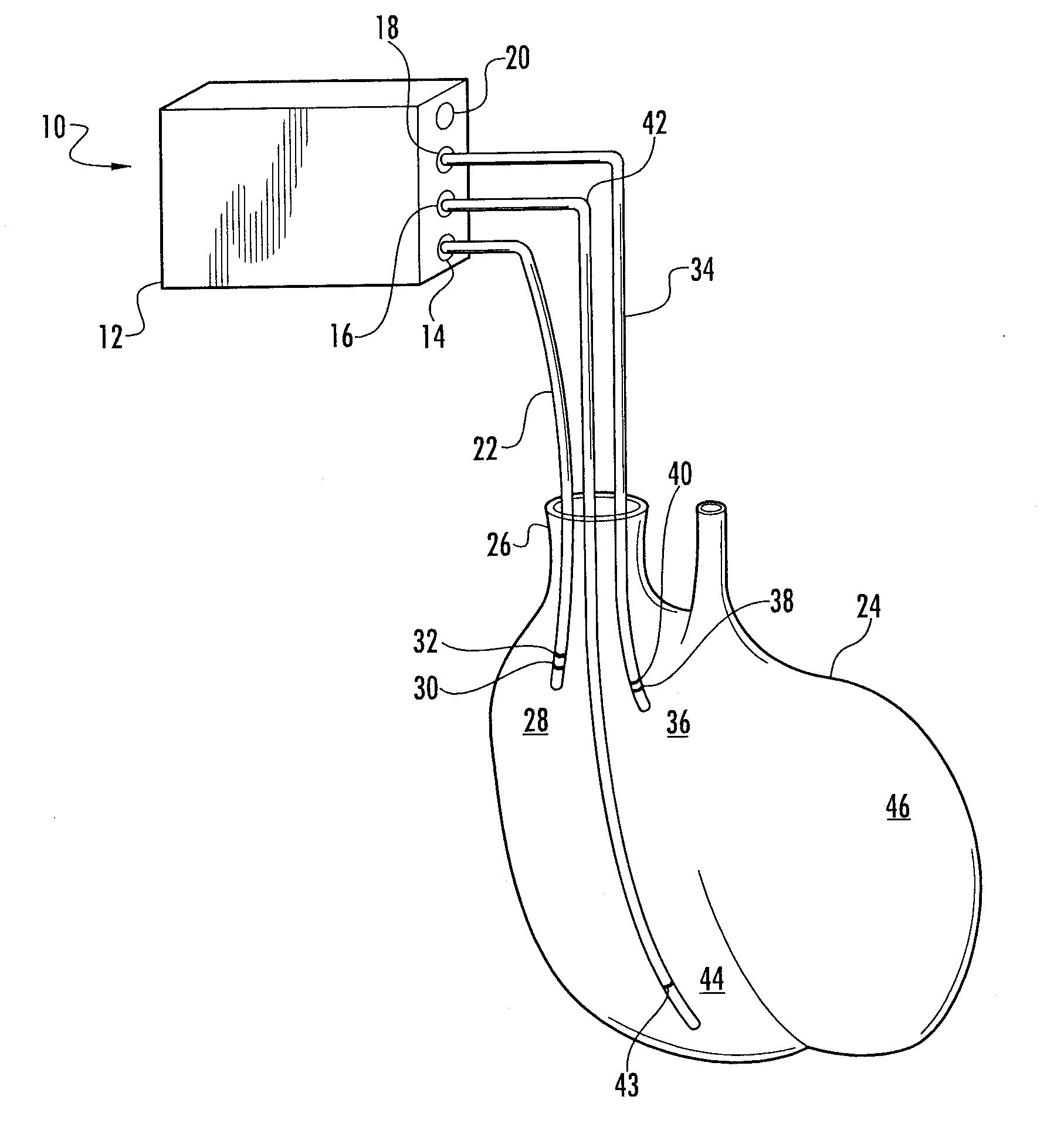Device And Method For Peri-Hisian Pacing And/Or Simultaneous Bi-Ventricular or Tri-Ventricular Pacing For Cardiac Resynchronization