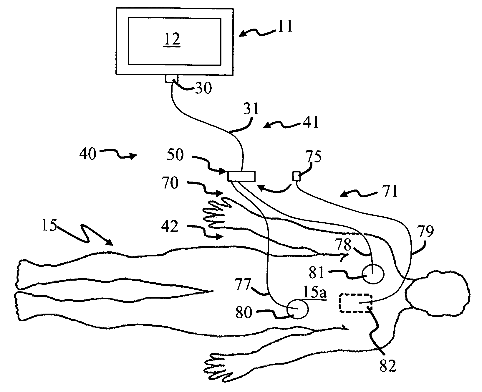 Electrode system for a physiological stimulator