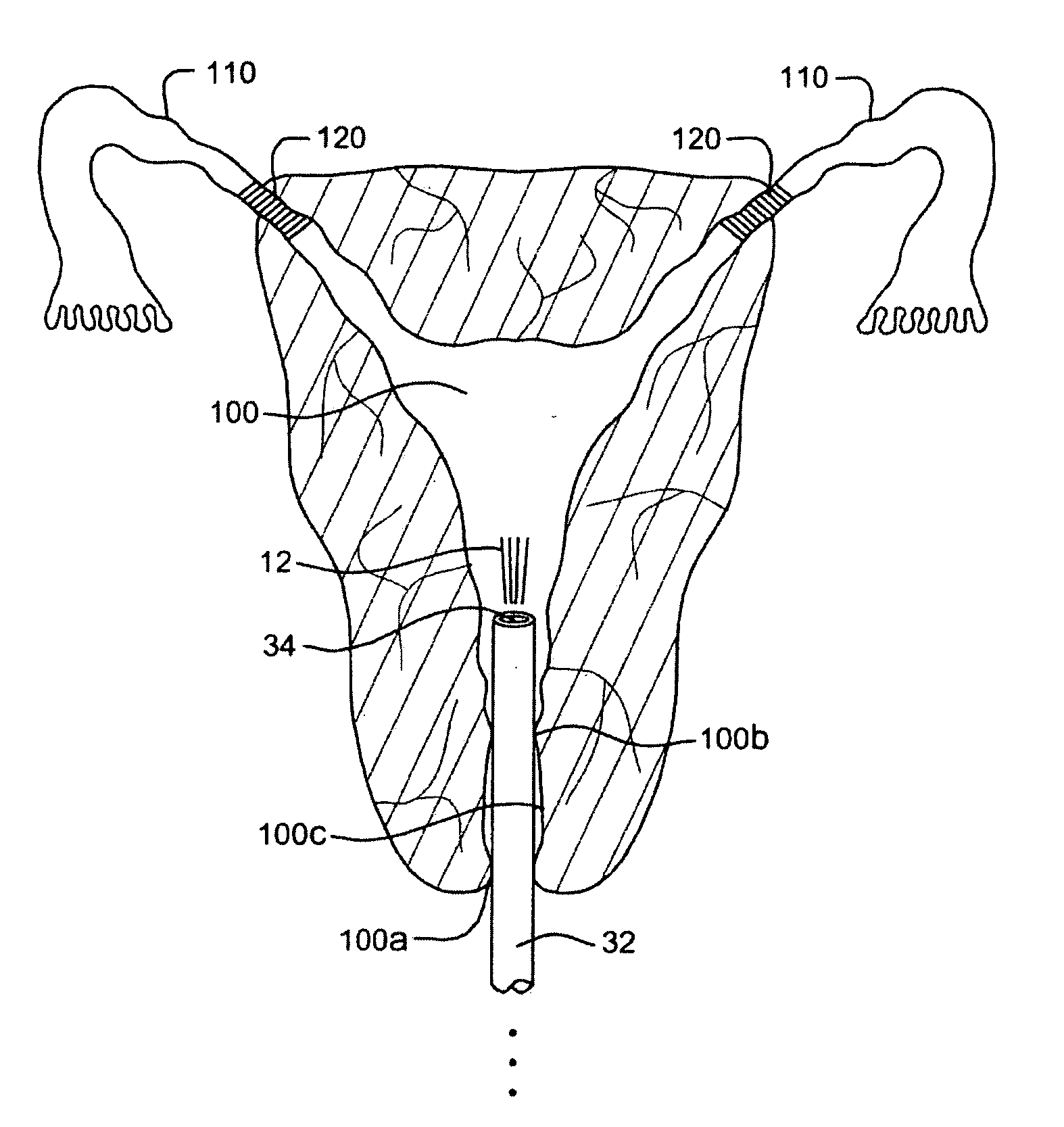 Method and apparatus for verifying occlusion of fallopian tubes