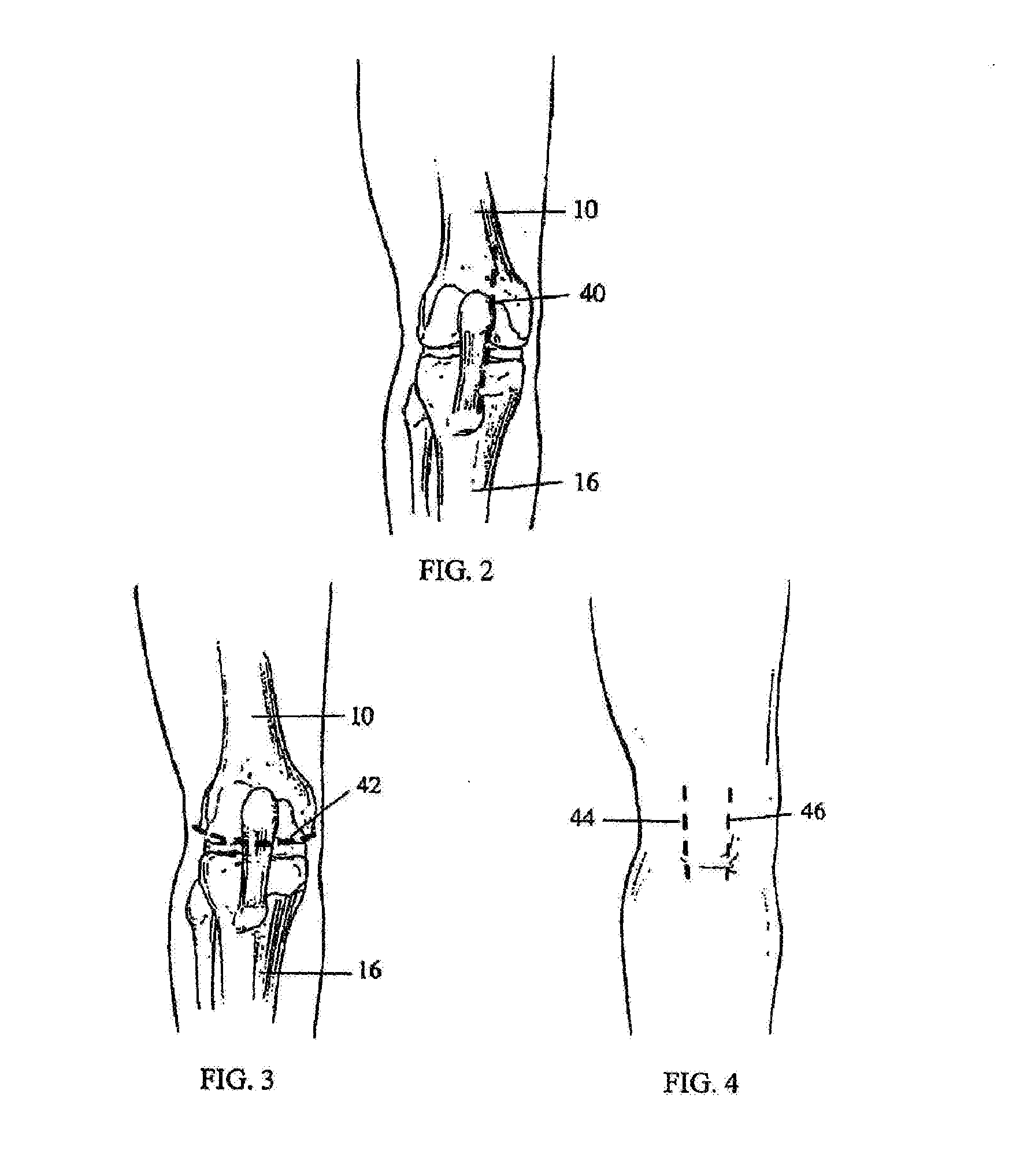 Apparatus and method for sculpting the surface of a joint